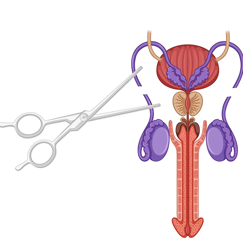 vasectomia