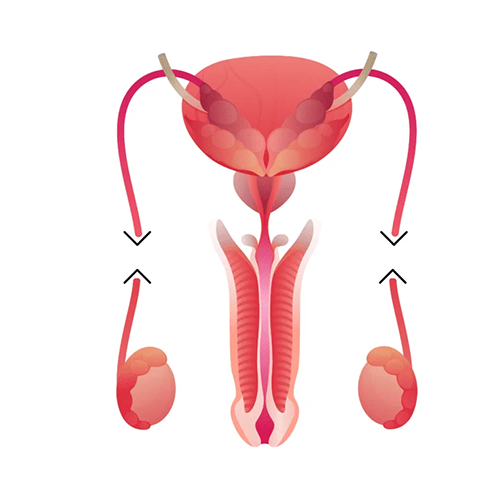 vasectomia