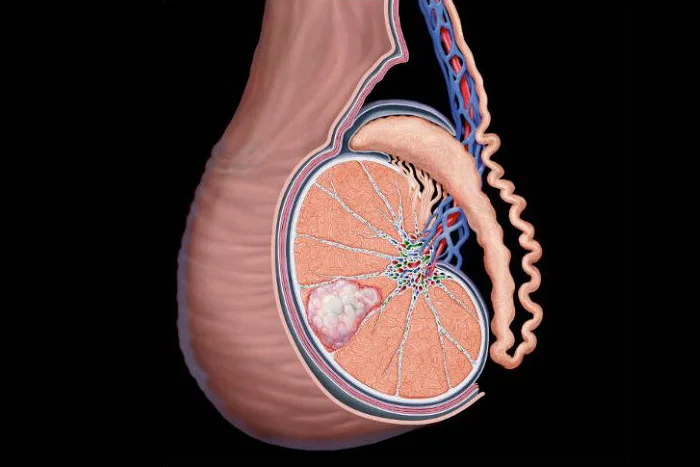 Câncer de Testiculo: Causas, Sintomas e Tratamento