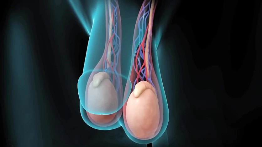 causas da varicocele