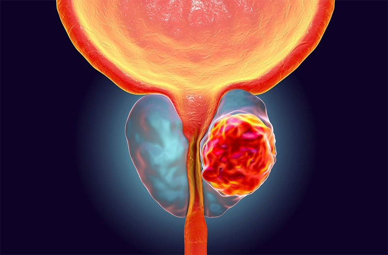 Câncer de Próstata: Causas, Sintomas e Tratamento