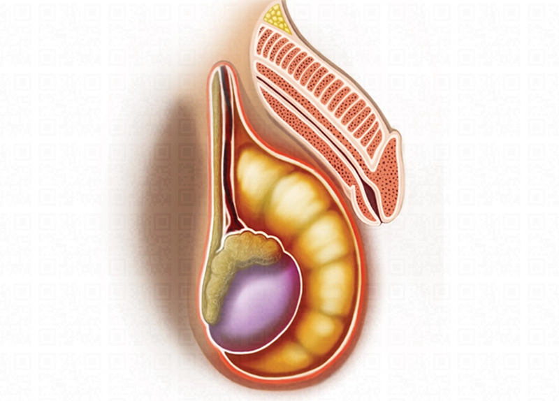Hidrocele: Causas, Sintomas e Tratamento