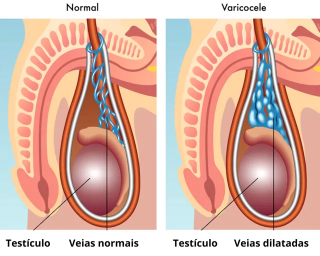 varicocele no tatuape